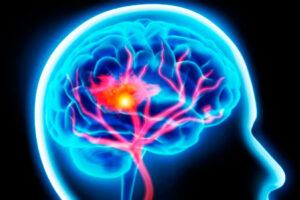 cerebro-avc