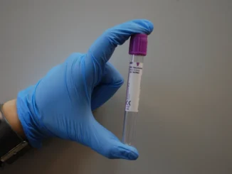 Diagnóstico do Alzheimer ganha exame de sangue aprovado pela Anvisa