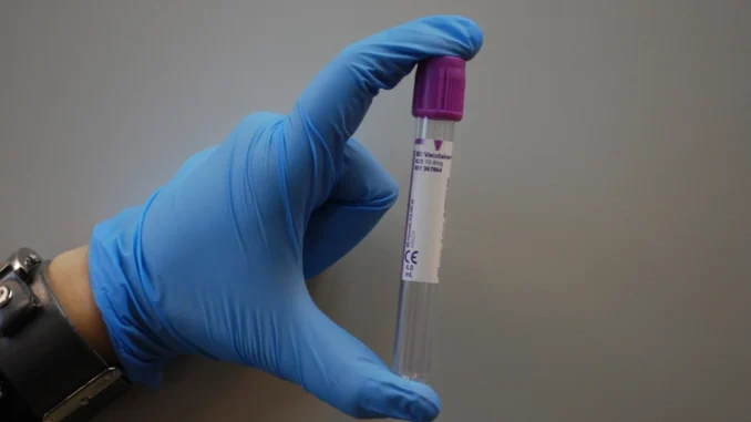 Diagnóstico do Alzheimer ganha exame de sangue aprovado pela Anvisa